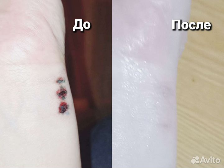 Удаление тату