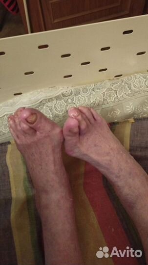 Медицинский педикюр аппаратный. Выезд на дому