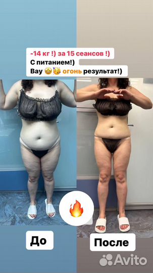 Аппаратный массаж, Похудение, LPG, RF -лифтинг