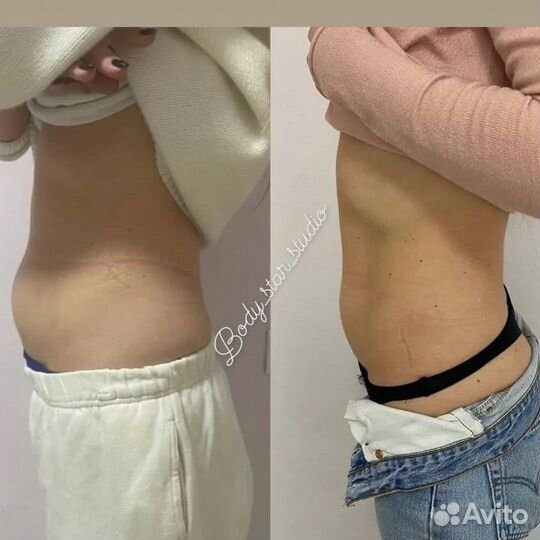 Криолиполиз похудение