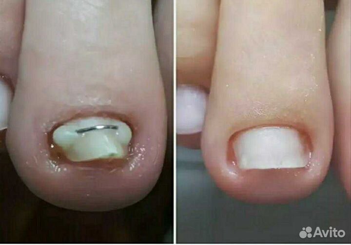 Педикюр. подология