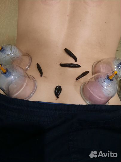 Купон на сеанс гирудотерапии