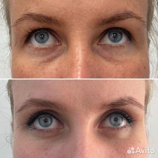 Верхняя блефаропластика