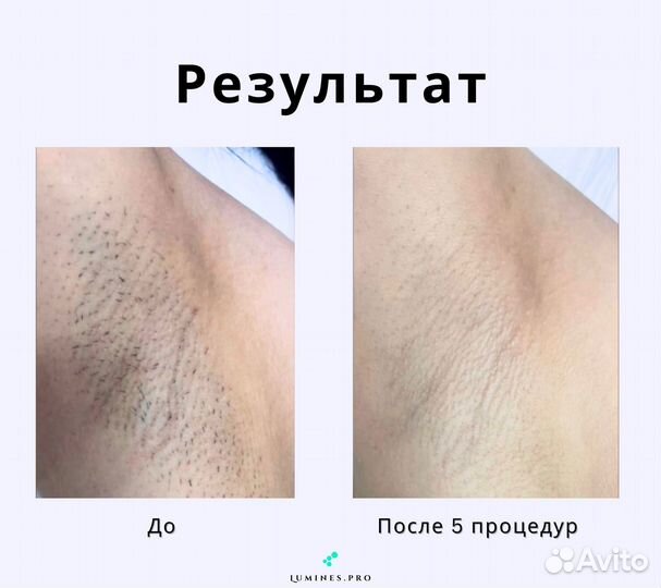 Диодный лазер «Lumines» Max’One 1200