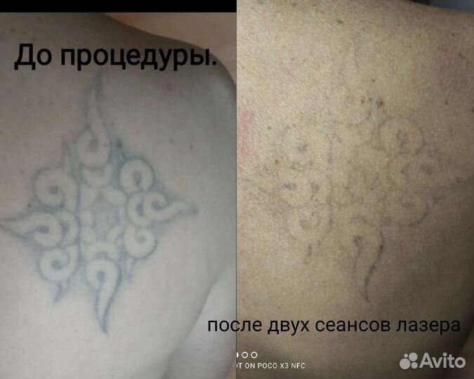 Удаление татуажа и татуировок. Лазер. Ремувер