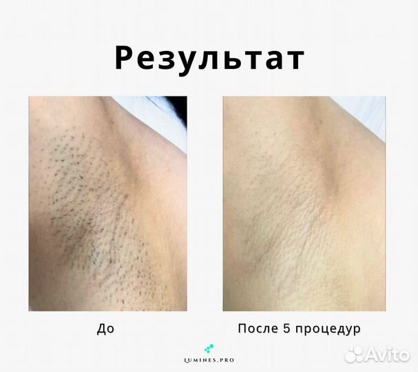 Диодный лазер Люминес’ максван 1200W