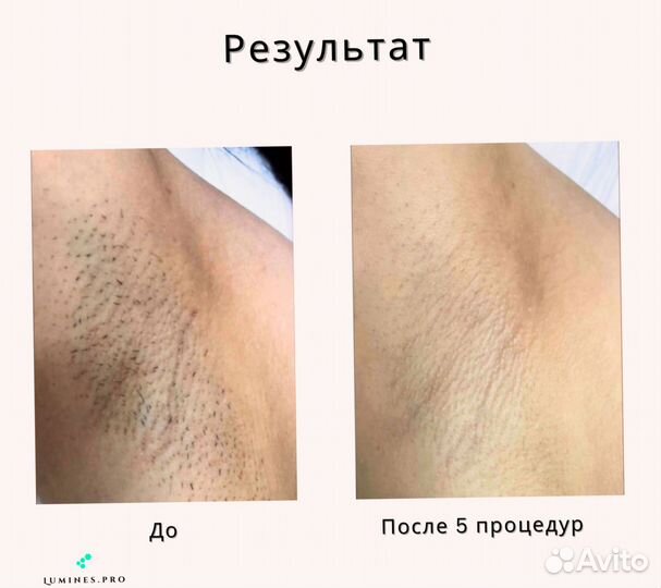 Диодный лазер для эпиляции люминес MaxPlus 2000W