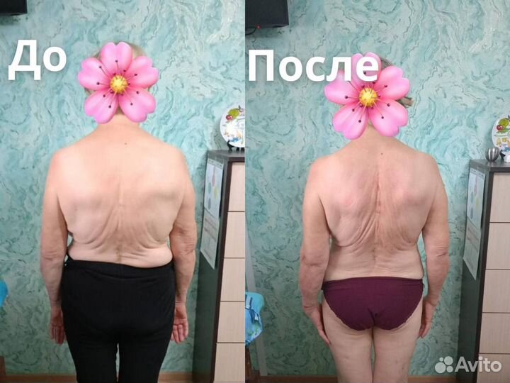 Массаж при остеохондрозе/ исправление осанки