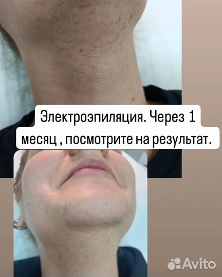 Лазерная эпиляция
