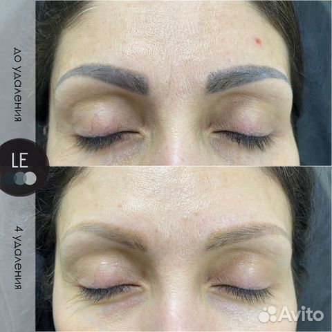 Удаление татуажа/тату на пикосекундном лазере