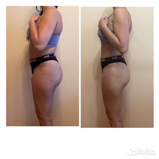 Субдермальный массаж Лимфодренажный массаж