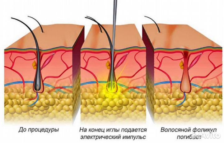 Электроэпиляция