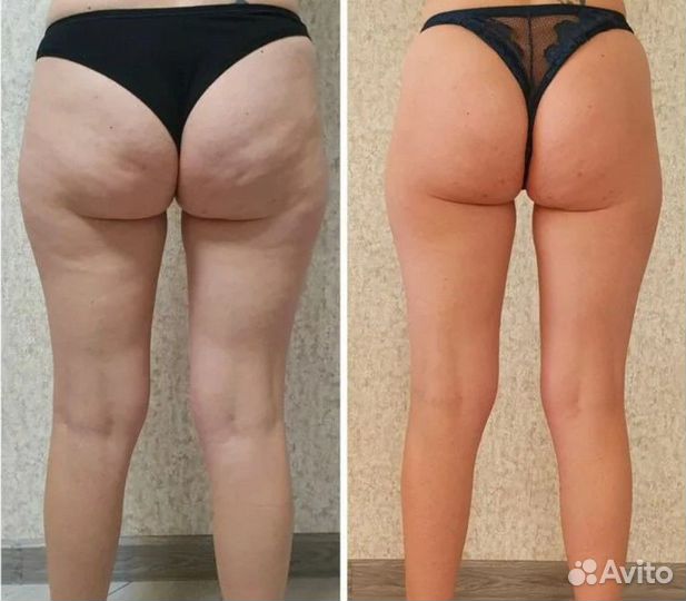 Массажист / lpg массаж