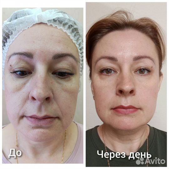 Аппаратное похудение