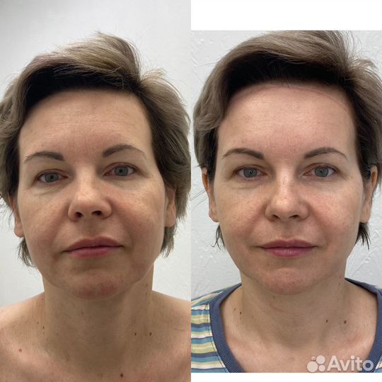 Чистка / Массаж / Пилинги / Уход/ Косметолог Светл