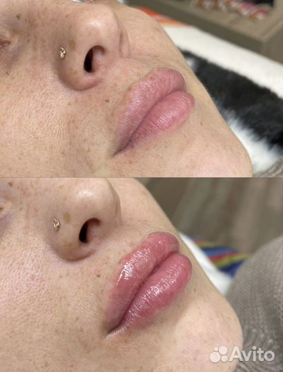 Модель на увеличение губ