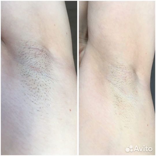 Элос эпиляция