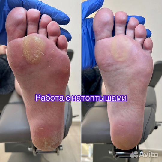 Подолог (вросший ноготь, мозоли, трещины)