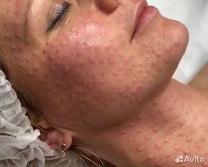 Биоревитализация