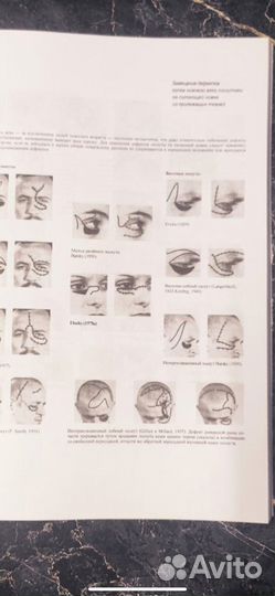 Пересадка кожи