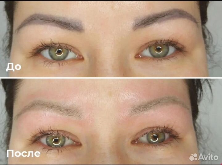 Удаление тутуировок и татуажа