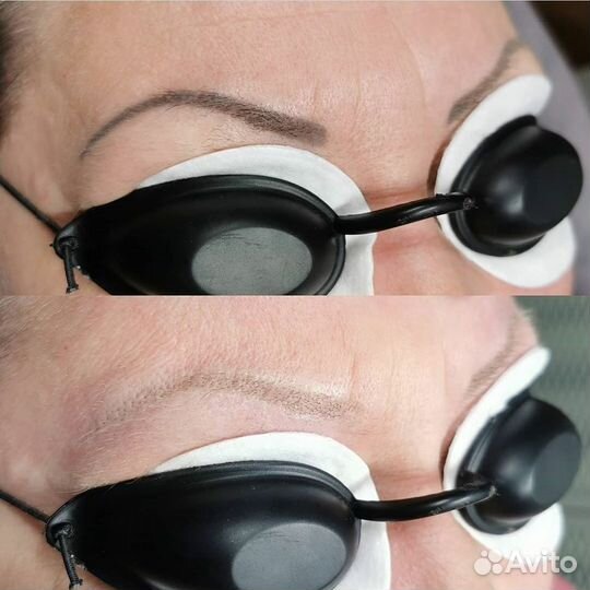 Удаление тату/татуажа