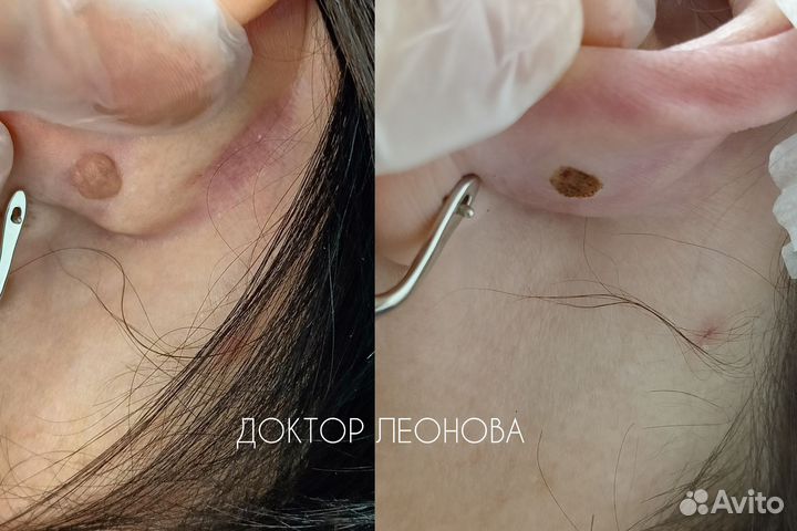 Удаление родинок папиллом у дерматолога