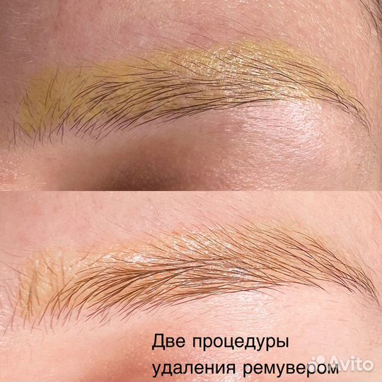 Удаление татуажа и тату лазером Lastik и ремувером