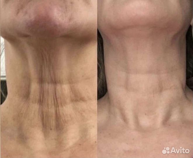 Rf лифтинг микроигольчатый