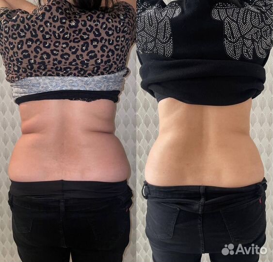 LPG массаж, микроигольчатый RF-лифтинг, кавитация