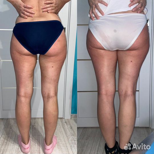 Lpg массаж/вибромассаж G5/кавитация/липолиз/рф