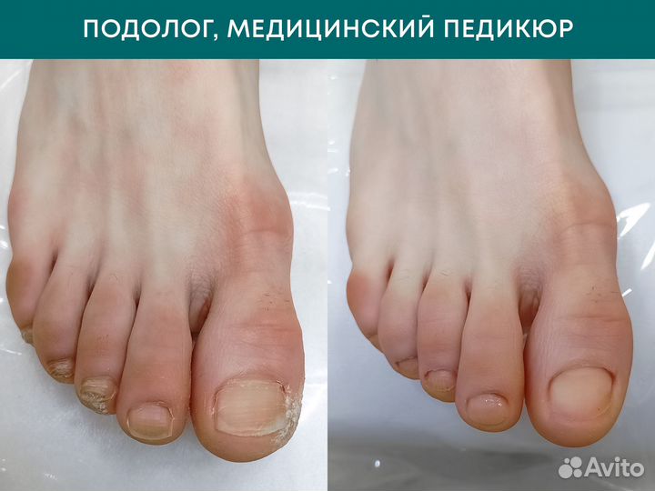 Подолог, медицинский педикюр у врача-подолога