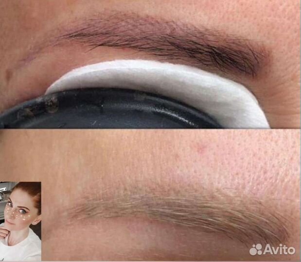 Лазерное удаление татуажа