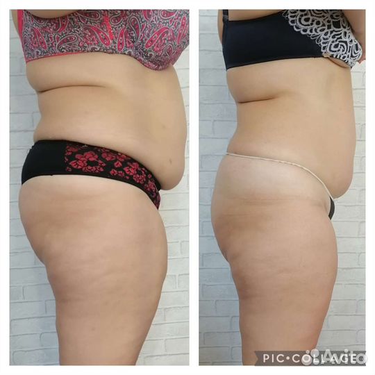 Субдермальный массаж Лимфодренажный массаж