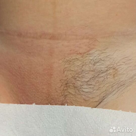 Лазерная эпиляция