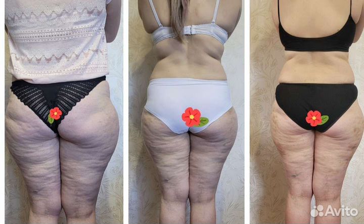 Массаж лица и тела. Lpg массаж. Коррекция фигуры