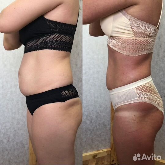 Антицеллюлитный массаж