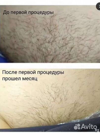 Электроэпиляции