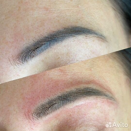 Удаление тату/татуажа