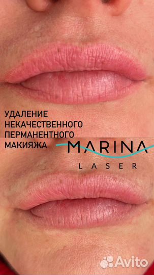 Модели на удаление тату и некачественного татуажа