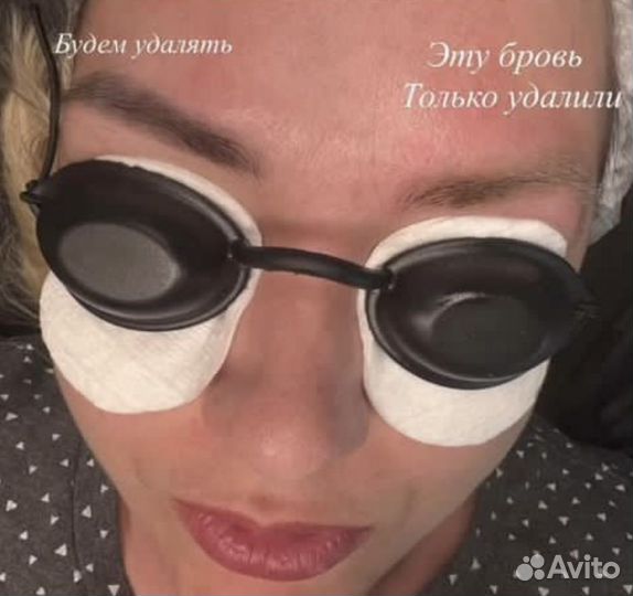 Удаление Татуажа и тату