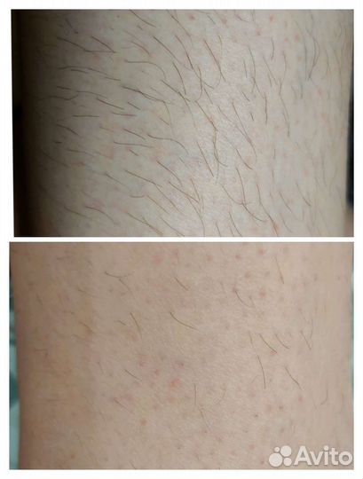 Электроэпиляция