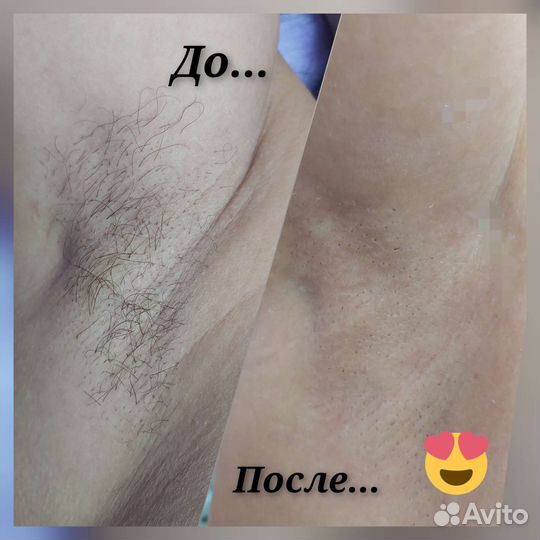 Восковая депиляция