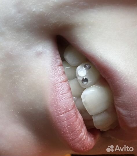 Установка скайсов