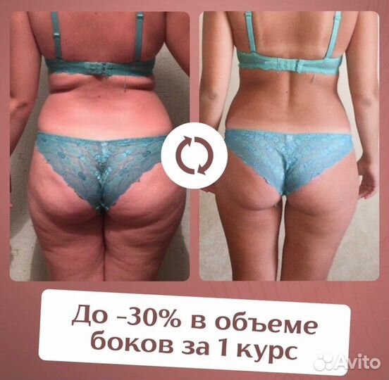 Кавитация. Эффект после первого сеанса