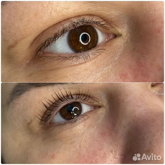 Липолитики тела, лицо