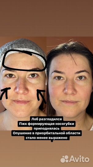 Массаж лица