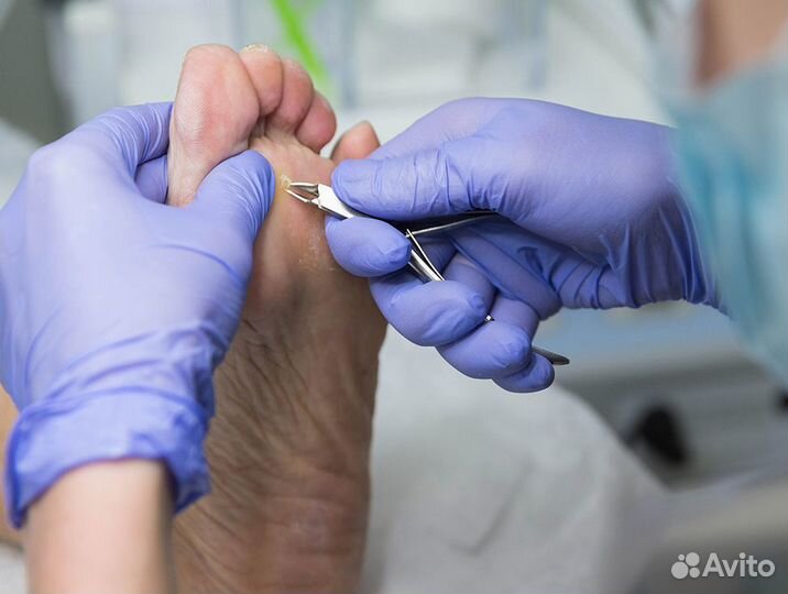 Медицинский (лечебный) педикюр - Подолог