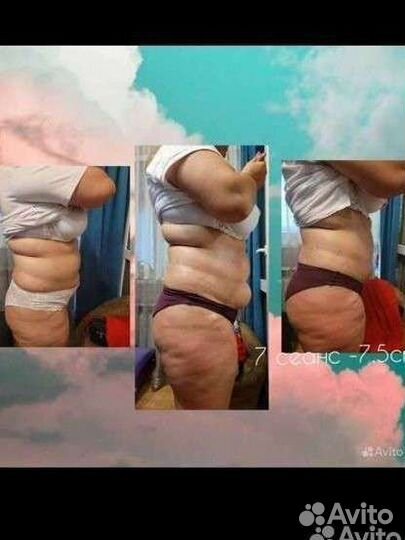 Аппаратный массаж:кавитация, рф-лифтинг липолиз