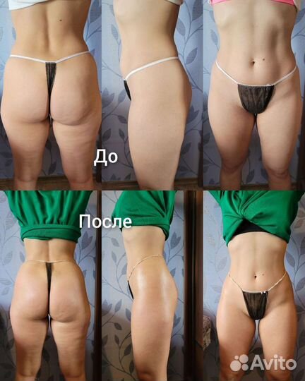 Антицеллюлитный массаж